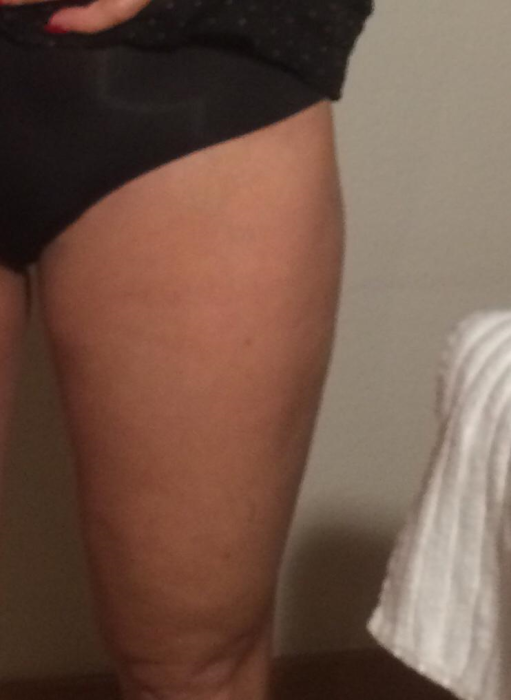 Inner thigh tone treatment 1 session