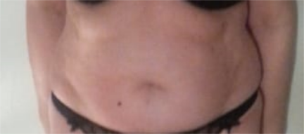 Fat reduction at the abdomen 2 sessions