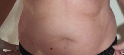 Fat reduction at the abdomen 2 sessions