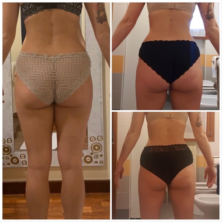 WORK IN PROGRESS FOR A BODY TREATMENT: CELLULITE PROGRAM AFTER 5 SESSIONS