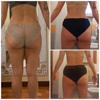WORK IN PROGRESS FOR A BODY TREATMENT: CELLULITE PROGRAM AFTER 5 SESSIONS