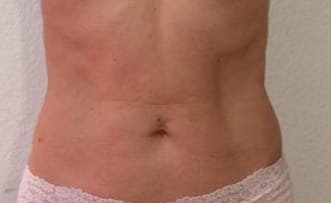 Toning of the abdomen 1 session