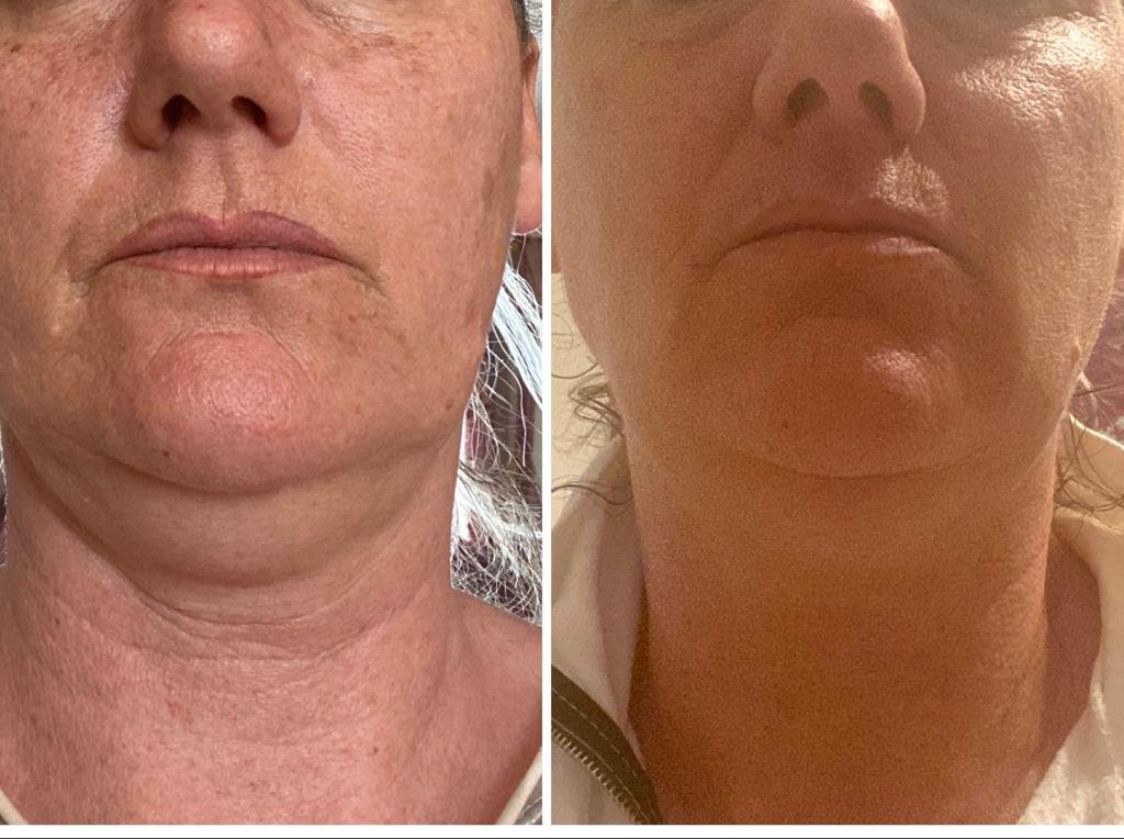 Incredible result on the double chin