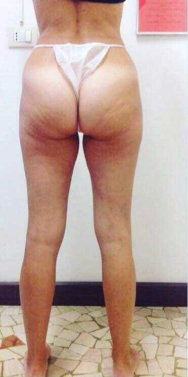 Riduzione cellulite e rimodellamento gambe e glutei in 6 sedute