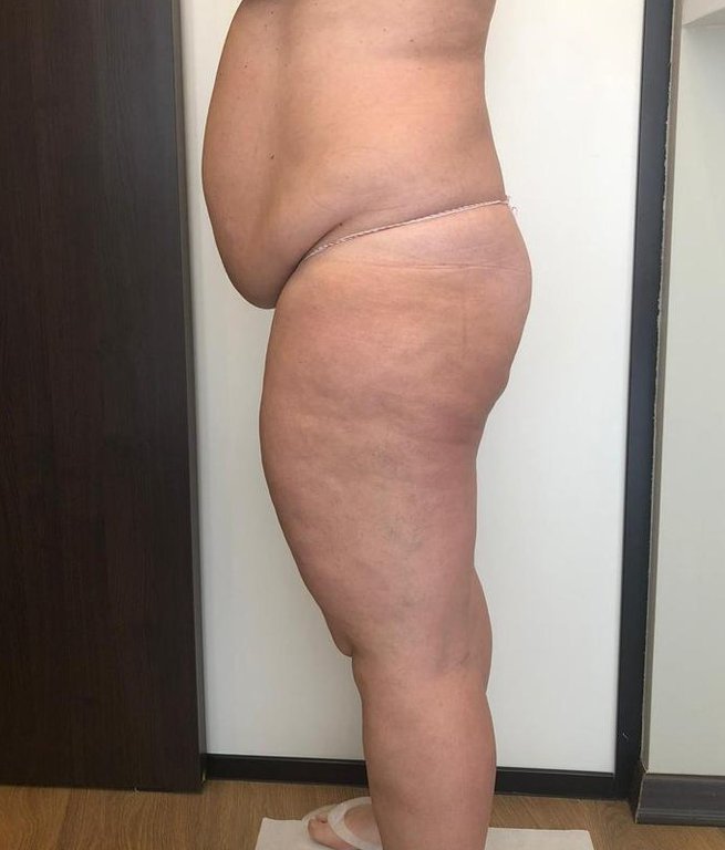 WORK IN PROGRESS FOR A BODY TREATMENT: CELLULITE PROGRAM AFTER 5 SESSIONS