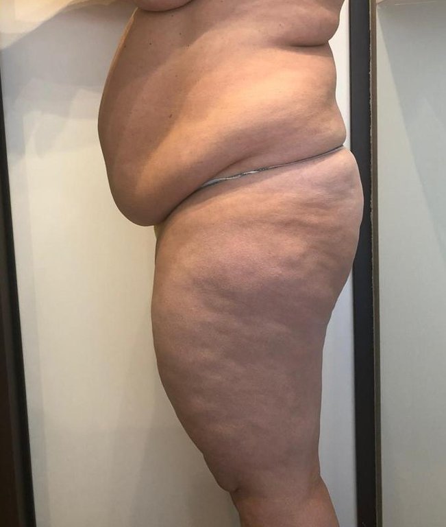 WORK IN PROGRESS FOR A BODY TREATMENT: CELLULITE PROGRAM AFTER 5 SESSIONS